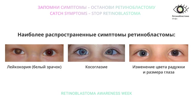 О злокачественной опухоли глаз у детей - ретинобластоме